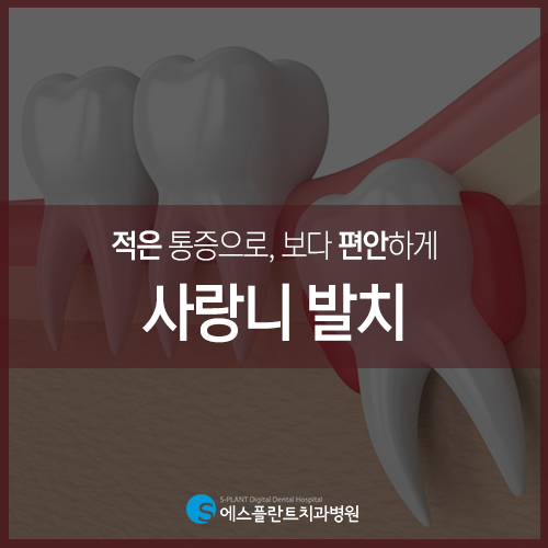 사랑니 발치, 적은 통증으로 편안하게 [에스플란트 치과병원] 관련 이미지 3