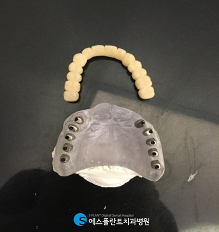 치아를 즉시 사용해야 한다면? 에스플란트치과에서 즉시기능임플란트 하세요! 관련 이미지 4
