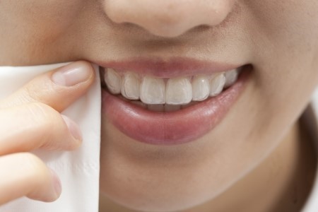 [자가미백효과] 자가치아미백 주의사항, 자가치아미백 과정 관련 이미지 8