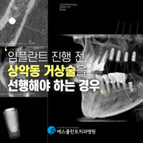 섬세함이 필요한 상악동 거상술도 에스플란트 치과병원과 함께하세요 관련 이미지 3