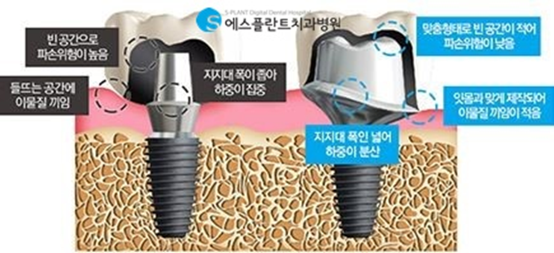 하악 전치부 치아손상, 임플란트로 심미성을 회복하세요! 관련 이미지 6