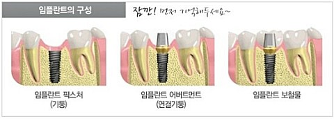 [임플란트가격]임플란트가격비교, 임플란트 선택기준 신중하게 관련 이미지 4