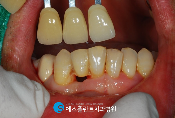 웃을 때 잘 보이는 전치부!하악 전치부 임플란트 치료 사례입니다. 관련 이미지 1