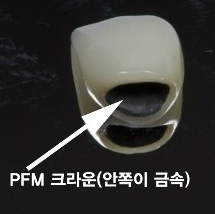 노인 임플란트 보험을 통해 경제적 부담을 줄이자 [에스플란트 치과병원] 관련 이미지 6