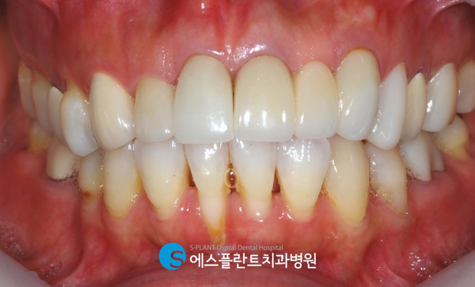 전치부 치근외흡수로 인한 임플란트 시술이 가능한 치과, 강남 에스플란트치과병원 관련 이미지 3