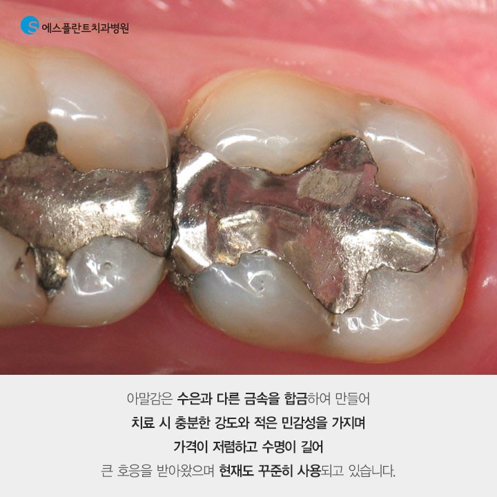 아무도 몰랐던 비밀스러운 [아말감] 관련 이미지 2