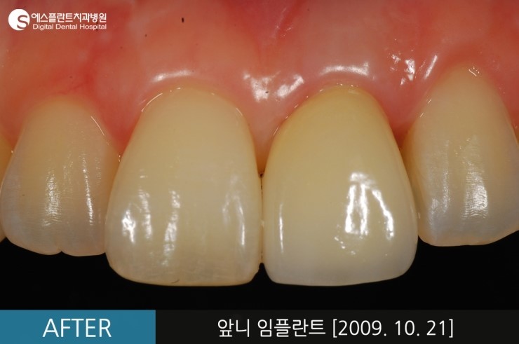 [뼈이식임플란트] 앞니 임플란트, 뼈이식 앞니 임플란트 전후 CASE 관련 이미지 6