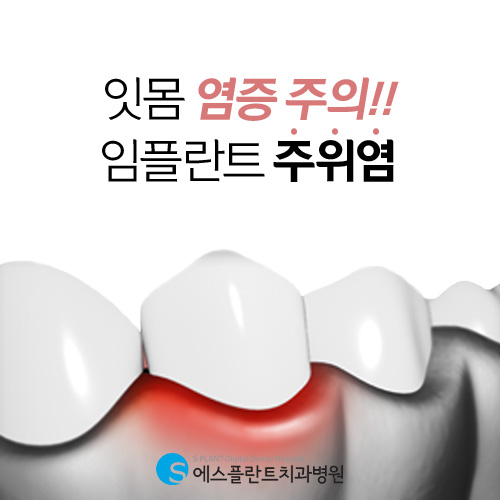 임플란트 재수술이 필요한 경우는 ? [에스플란트 치과병원] 관련 이미지 4