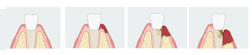 임플란트 주위염 원인과 예방법은? &ndash; 에스플란트치과병원 관련 이미지 2