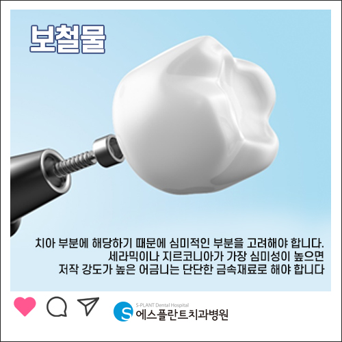 임플란트 재수술도 실력이 검증된 에스플란트 치과병원에서 관련 이미지 3