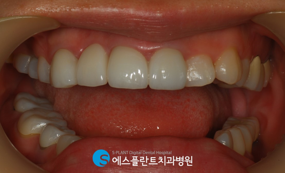 강남 잇몸치료, 치은절제술(gingivectomy)이 가능한 치과를 찾고 있다면?! 관련 이미지 2