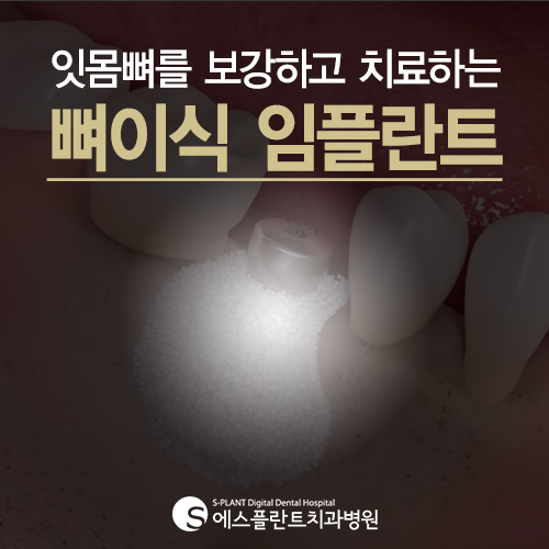 뼈이식 임플란트, 의료진의 실력이 중요합니다. [에스플란트 치과병원] 관련 이미지 2