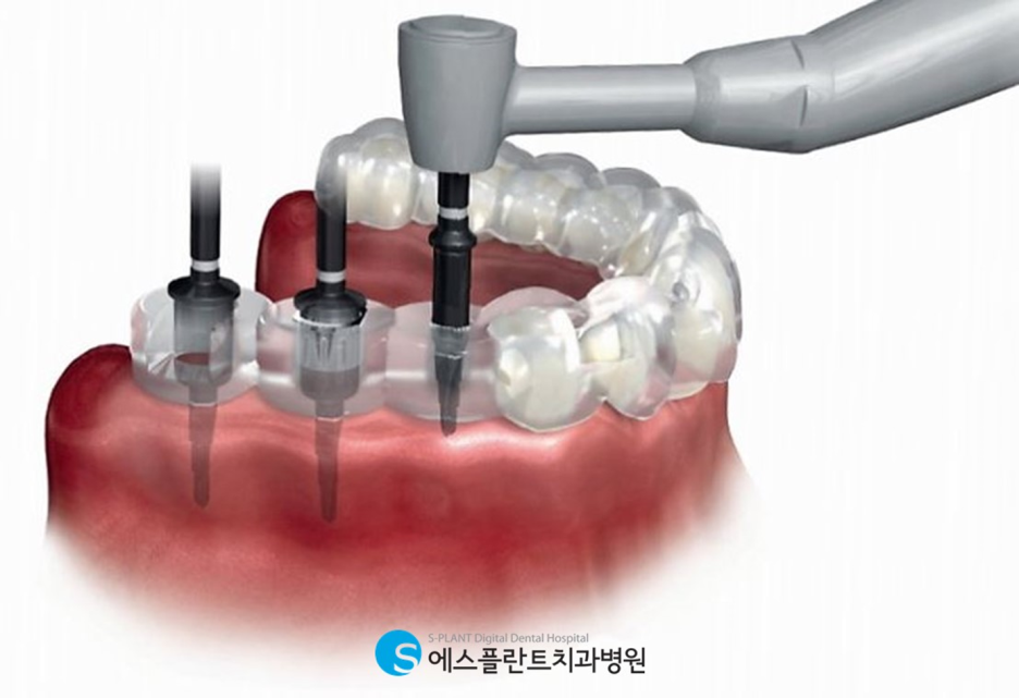 앞니 임플란트 잘하는 강남 치과, 에스플란트치과병원의 만족도 높은 앞니 심미 임플란트 관련 이미지 4