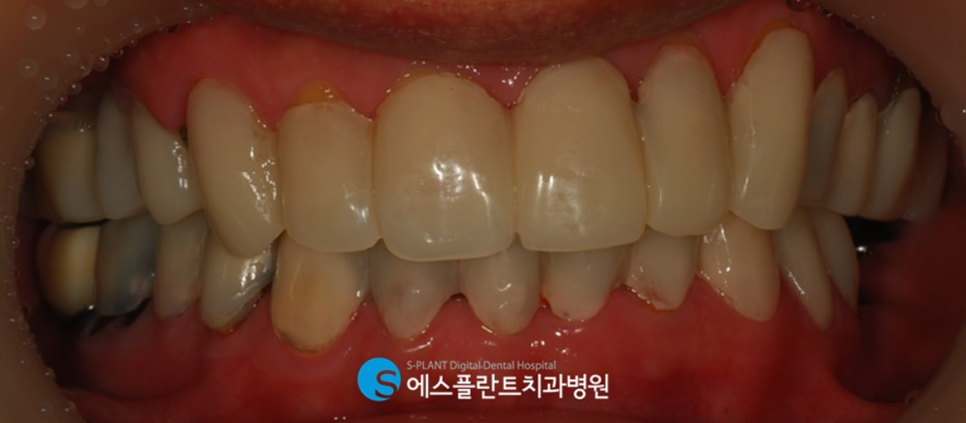 심미보철 치료 잘하는 치과 에스플란트치과병원의 지르코니아 보철 관련 이미지 4