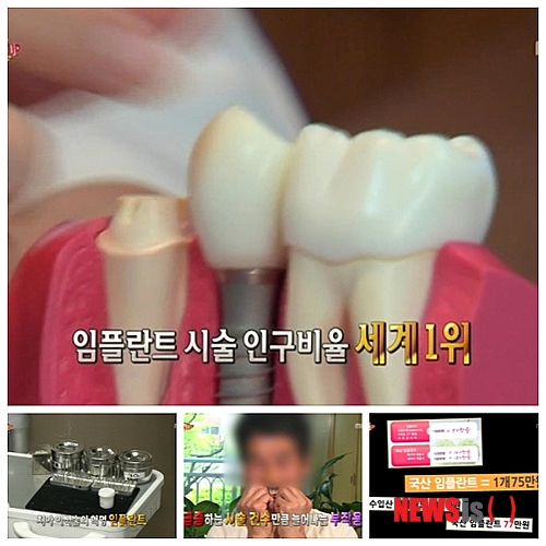 임플란트 부작용 예방하려면 관련 이미지 1