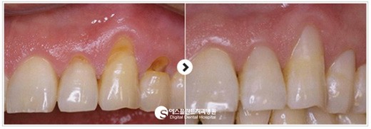[시린이 치료] 시린 이에 대한 모든 것 2편_시린 이 치료 방법 관련 이미지 3