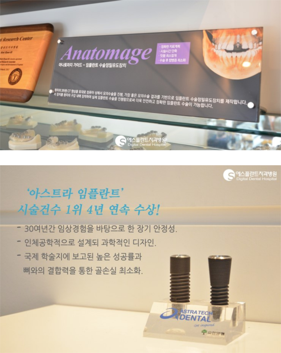 [당일임플란트/임플란트과정]강남임플란트잘하는곳,디지털화된즉시 기능임플란트! 관련 이미지 4