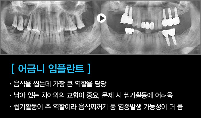 임플란트, 나에게 맞는 임플란트치료를 확인하세요. 관련 이미지 4