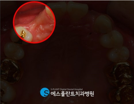 강남 임플란트 잇몸뼈 부족 시, 에스플란트 치과병원의 골이식 임플란트(GBR)로 관련 이미지 4