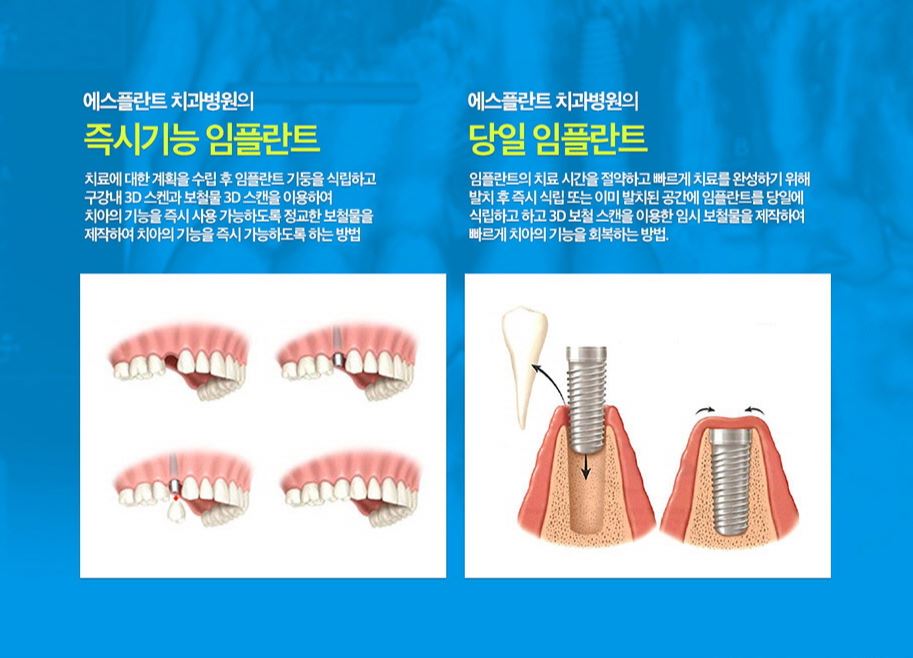 청담동 치과, 나에게 꼭 맞는 곳을 찾자 [에스플란트 치과병원] 관련 이미지 6