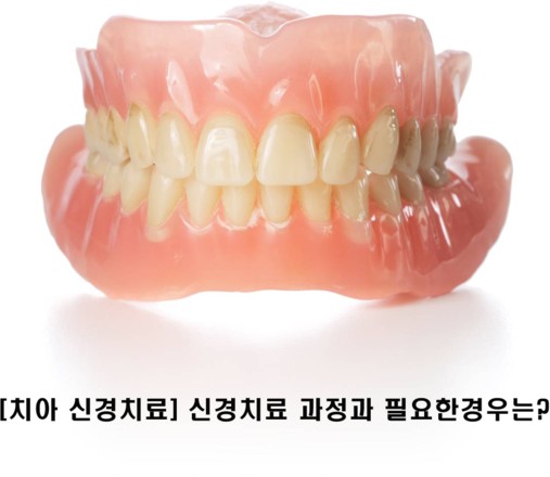 [치아 신경치료] 신경치료 과정과 필요한 경우는? 관련 이미지 1