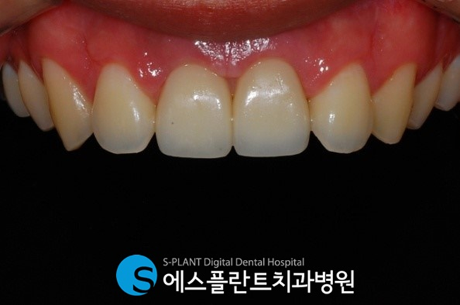 부러지고, 깨진 앞니!  앞니임플란트로 원래의 모습을 되찾을 수 있습니다. 관련 이미지 4