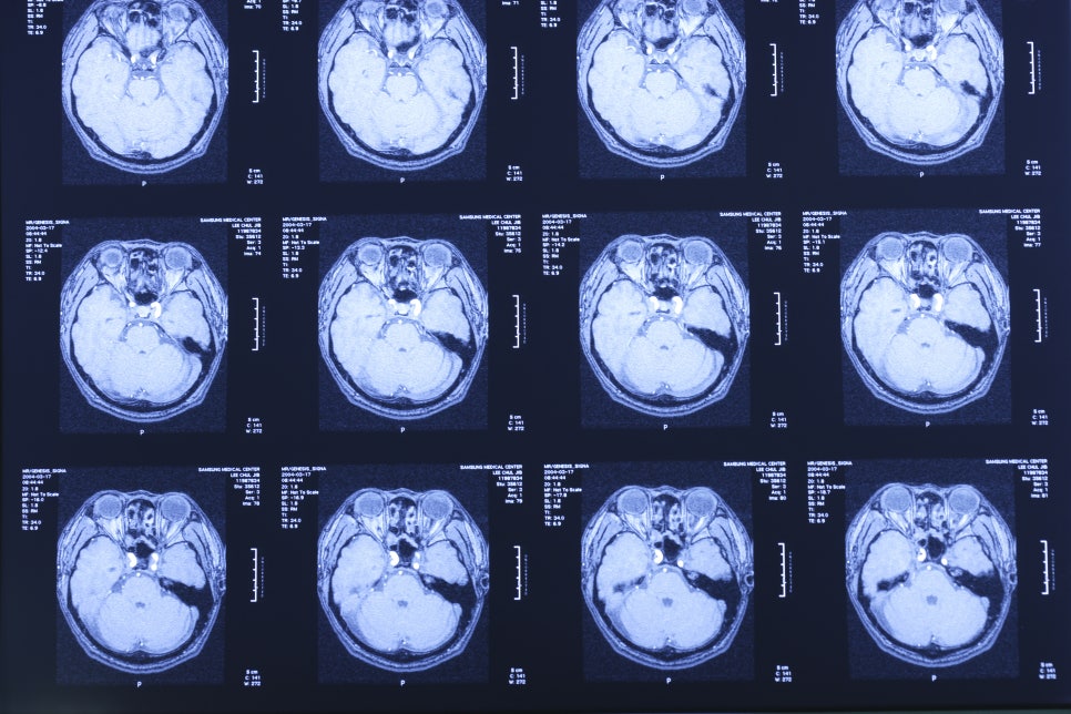 임플란트 했는데 MRI 찍어도 될까요? [에스플란트 치과병원] 관련 이미지 4