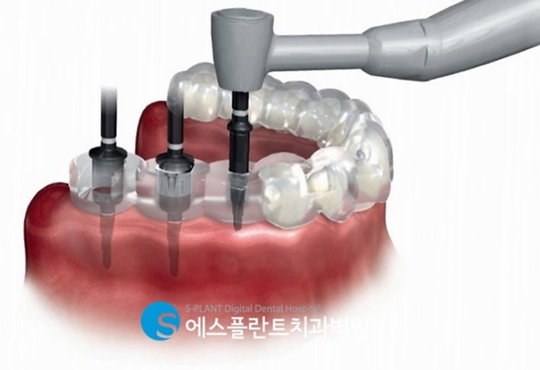 전체임플란트 이렇게 진행됩니다! 관련 이미지 5