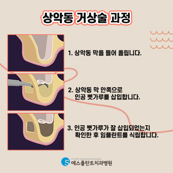어금니임플란트 전 상악동거상술이 필요한 경우는? 관련 이미지 3