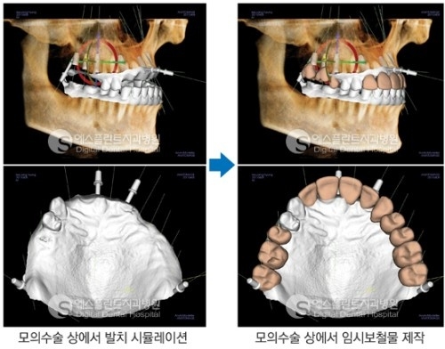 전체임플란트, 당일 임플란트 시술과정 관련 이미지 4