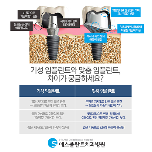 맞춤형임플란트로 주위염 예방하세요. – 에스플란트치과병원 관련 이미지 3