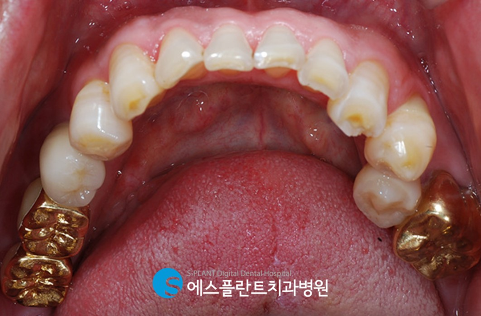 심한 충치로 인한 심미보철 및 임플란트 치료 잘하는 압구정로데오역 치과, 에스플란트치과병원 관련 이미지 6