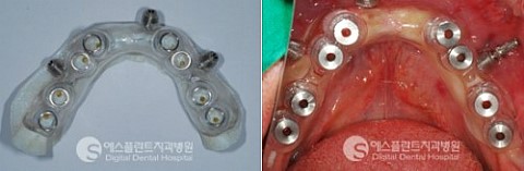 노벨가이드 vs 아나토마지가이드 임플란트 관련 이미지 8