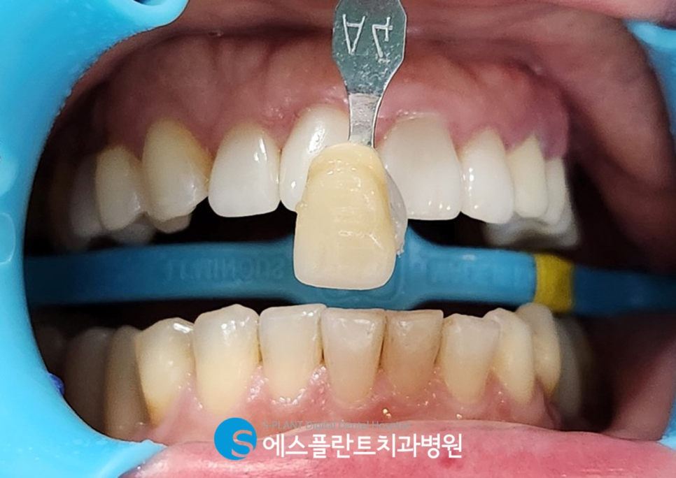 누런 치아로 고민이라면?! 에스플란트치과병원 원데이 강남 전문가 치아미백으로 하얗게 관련 이미지 2