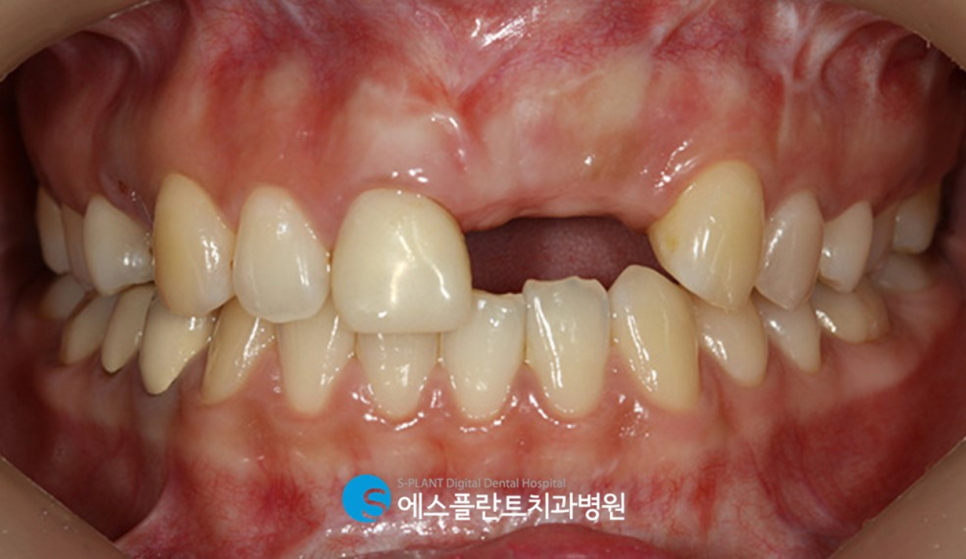 고난이도 앞니 심미 임플란트는 강남 에스플란트치과병원에서 관련 이미지 2