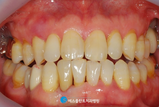 하악 전치부 치아손상, 임플란트로 심미성을 회복하세요! 관련 이미지 7
