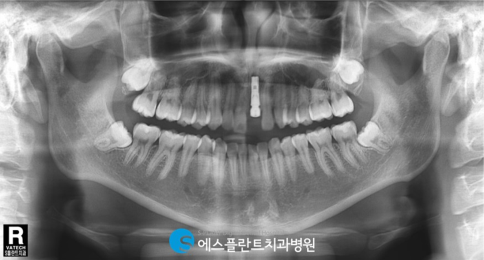 치아외상으로 인한 전치부 심미보철 임플란트는 강남 에스플란트 치과병원에서 관련 이미지 5