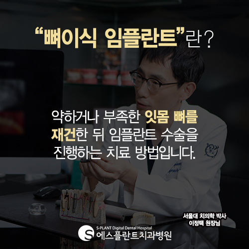임플란트 골이식 나도 필요할까? &ndash; 에스플란트치과병원 관련 이미지 3