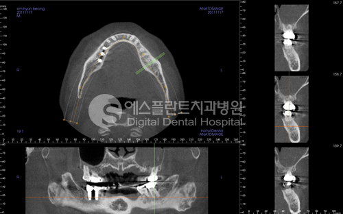 상악동거상술 어려운 만큼 믿을 수 있는 병원에서– 에스플란트치과병원 관련 이미지 3