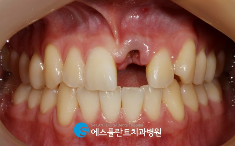 강남 발치 후 즉시임플란트 가능한 치과, 에스플란트 치과병원 관련 이미지 2