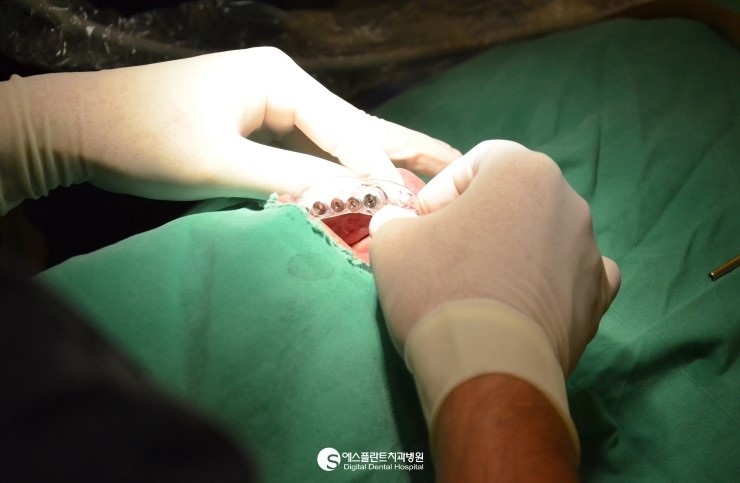 [어금니 임플란트 잘하는곳] 어금니 임플란트, 어금니 임플란트는 3D CT 임플란트로! 관련 이미지 2