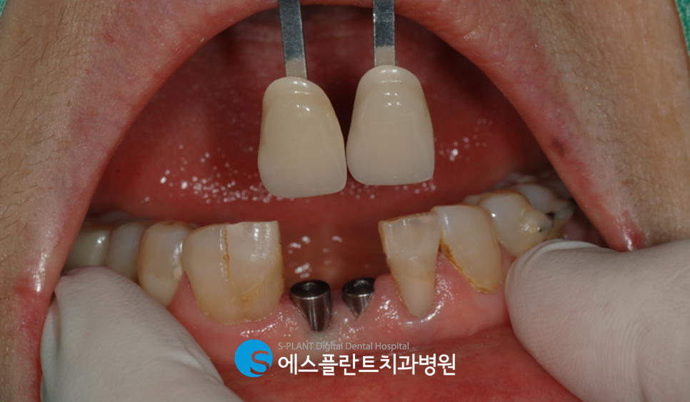 하악 앞니 임플란트 식립 잘하는 치과, 에스플란트 치과병원에서 정확하게! 관련 이미지 6
