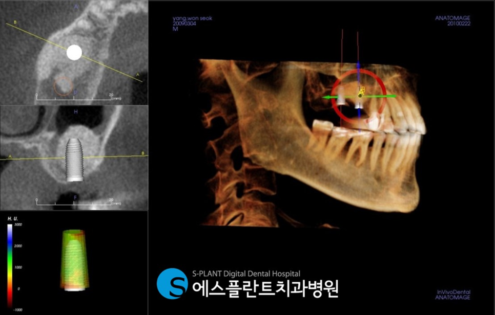 고난이도 상악동 거상술 임플란트 잘하는 치과, 에스플란트 치과병원 관련 이미지 5