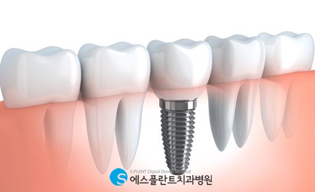 손상되고 상실된 치아를 대체하는 임플란트, 에스플란트치과에서 진행하세요! 관련 이미지 4