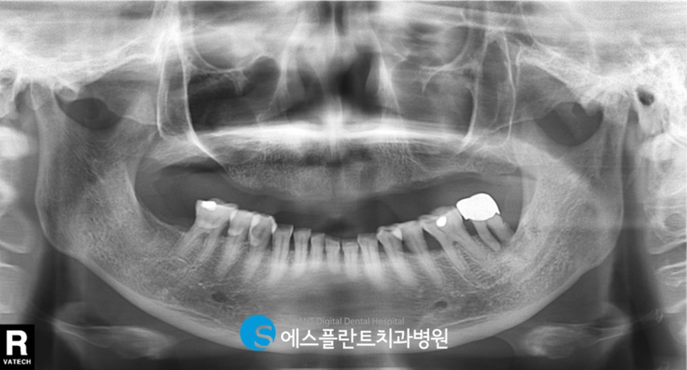 상악 무치악 환자 삶을 질을 높여주는 에스플란트치과병원의 상악 Full Case 임플란트 관련 이미지 1