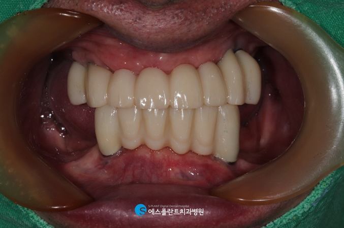 임플란트와 틀니의 장점만 모은 임플란트틀니 관련 이미지 7
