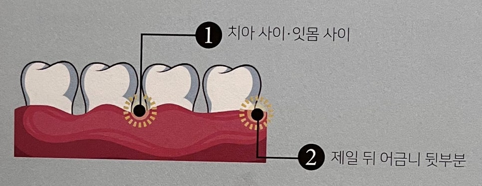 건강한 잇몸이 코로나 감염 및 합병증을 줄일 수 있다. [에스플란트 치과병원] 관련 이미지 5