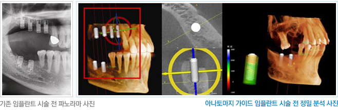 [뼈이식 임플란트] 임플란트잘하는치과, 잇몸 뼈 이식 꼭 해야만 하나요? 관련 이미지 5