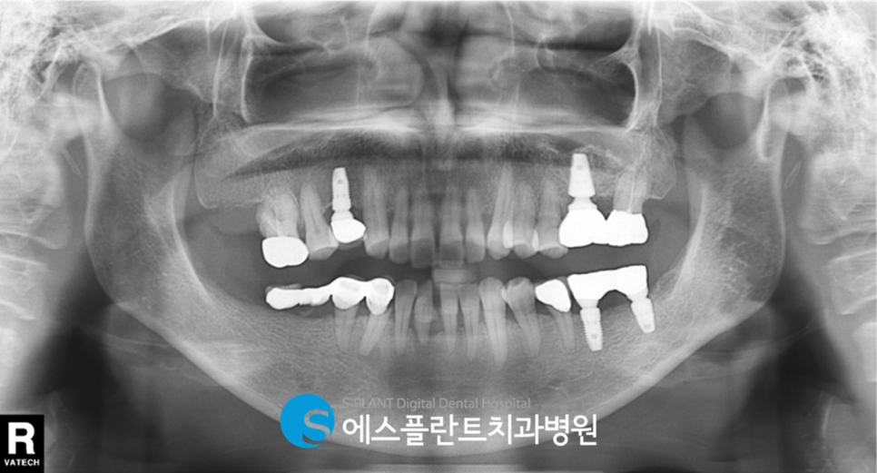 하악 대구치 임플란트 시 가이드 임플란트가 필요한 이유?! 하치조 신경 손상 피해 에스플란트 치과병원에서 정확하고 안전하게 관련 이미지 2