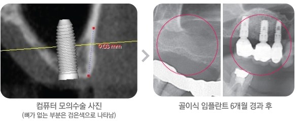 [뼈이식 임플란트] 뼈이식 임플란트, 꼭 필요한 뼈이식만 하세요. 관련 이미지 3
